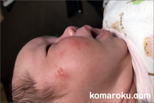 娘の顔の乳児湿疹